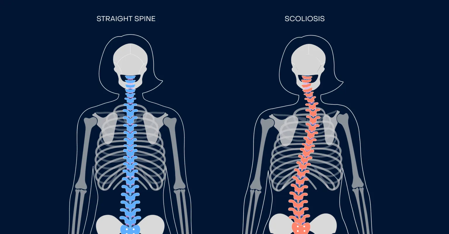 Illustration of adolescent idiopathic scoliosis showing spinal curvature