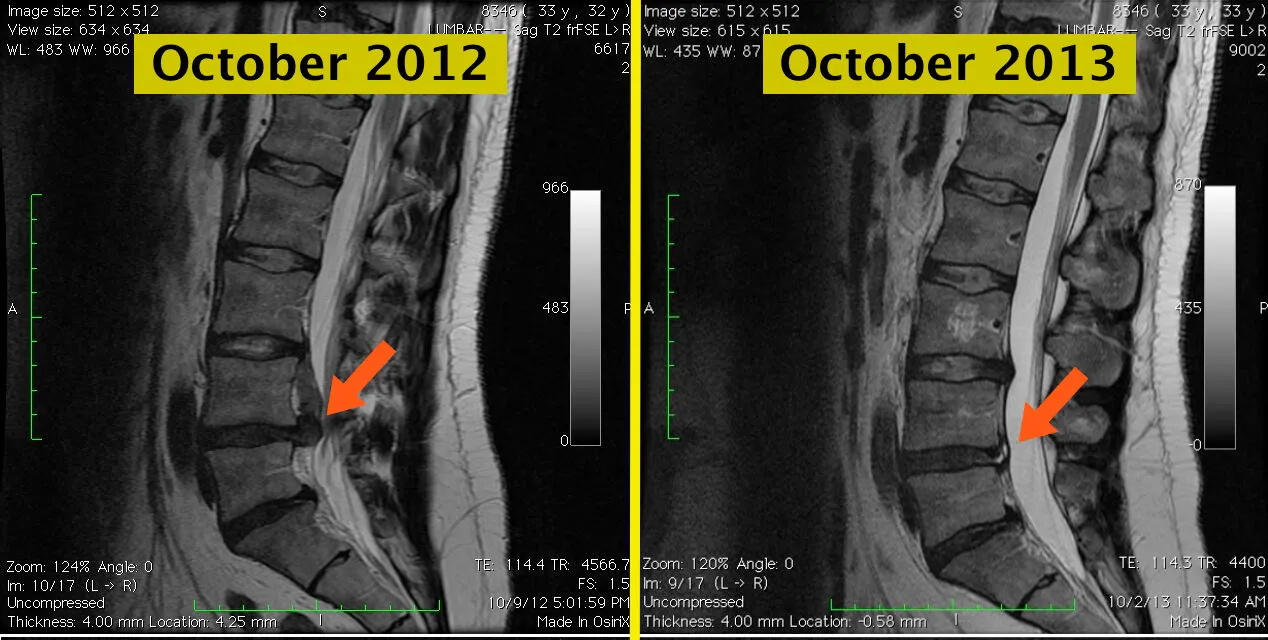 MRI series showing natural resorption of a lumbar disc herniation over time